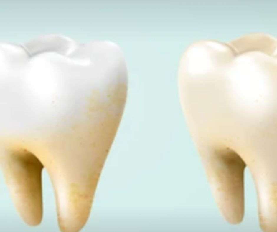 The Primary Causes of Enamel Stains